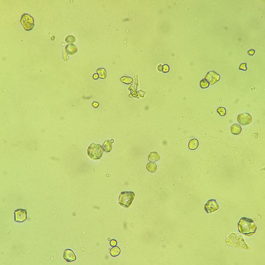Starch Granules in Urine