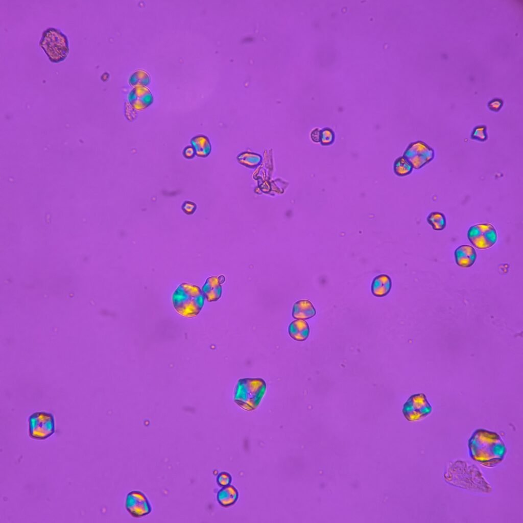 Starch Granules in Urine, Polarized