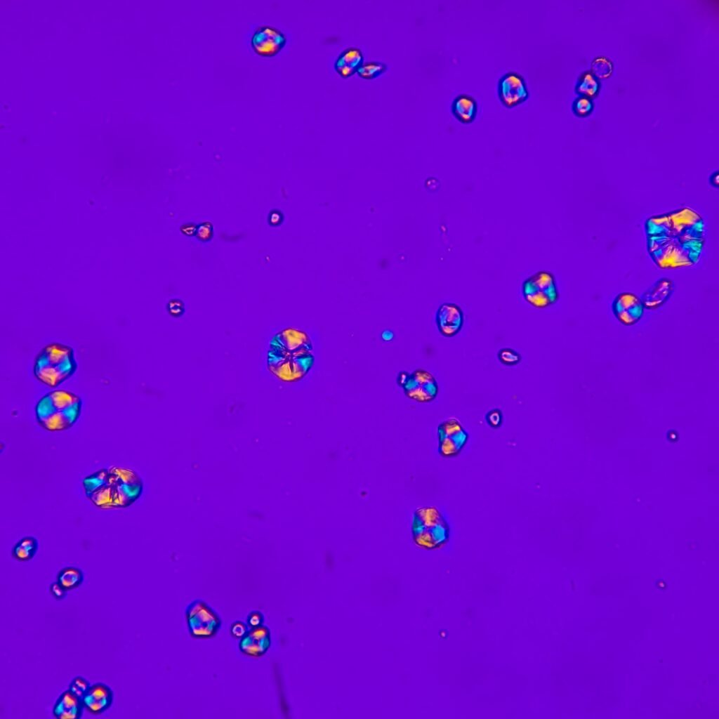 Starch Granules in Urine, Polarized
