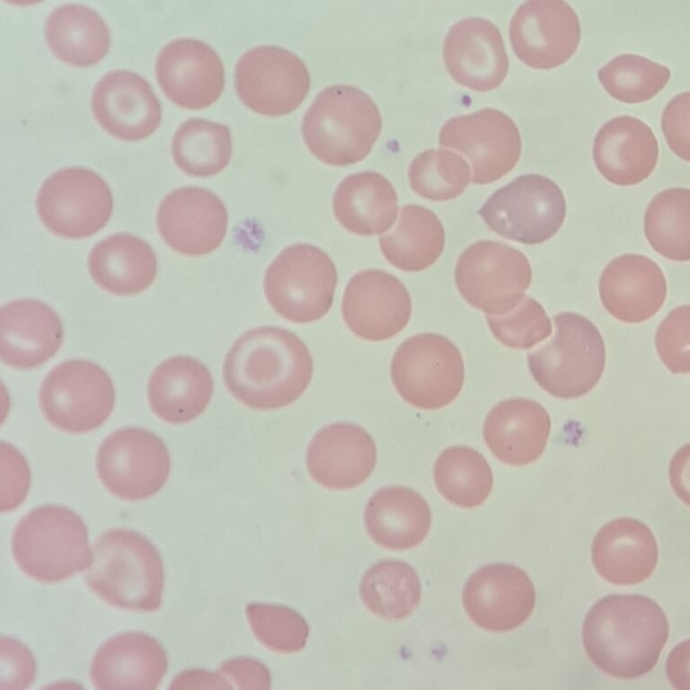 RBC Morphology Based on Shape