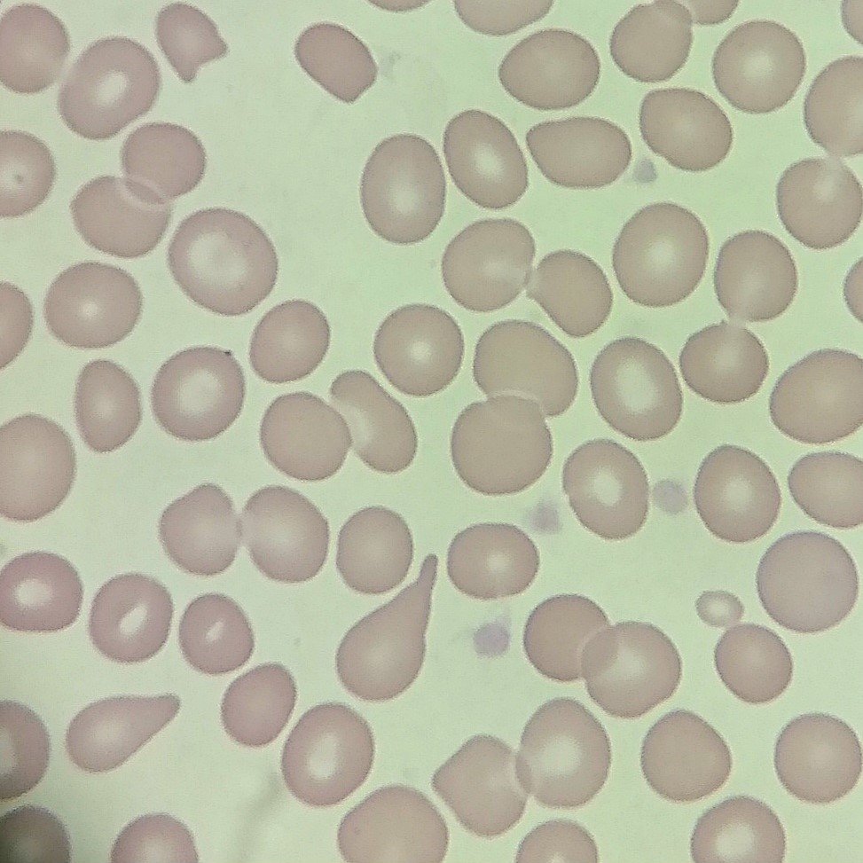 Teardrop Cells (Dacrocytes)