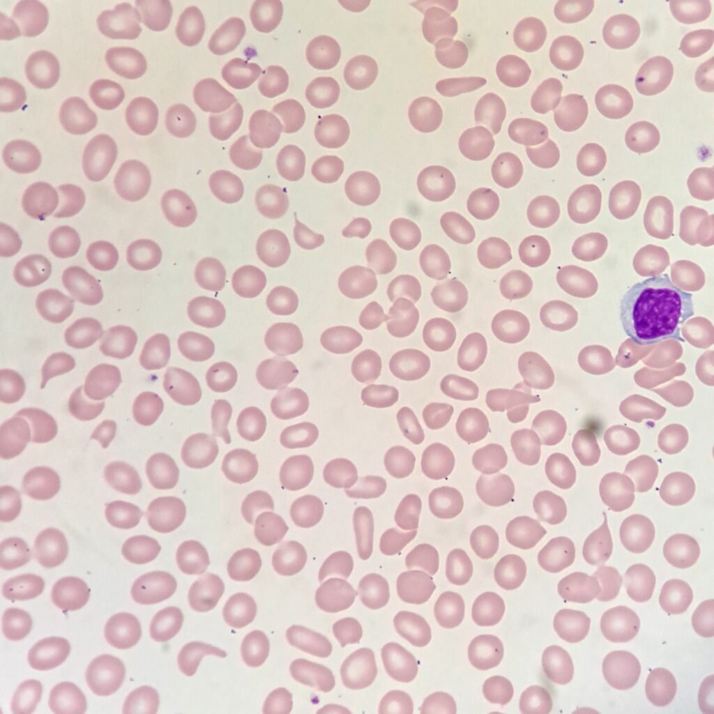 Teardrop Cells (Dacrocytes)