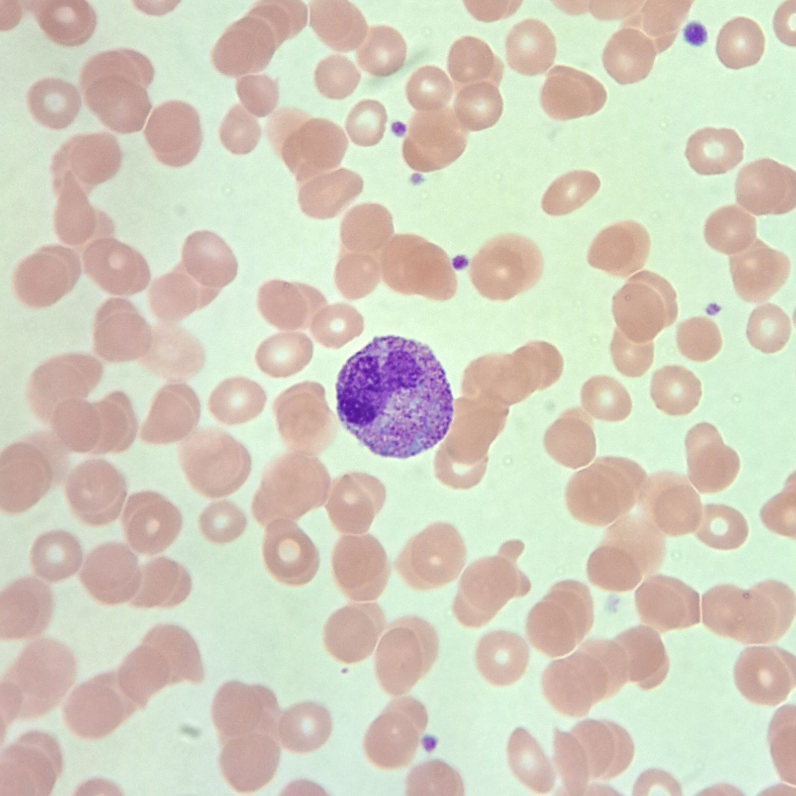 neutrophil with toxic granulation