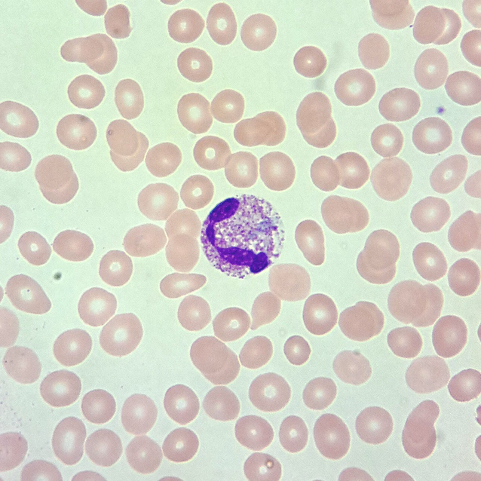 Toxic Granulation Appearance Clinical Significance MedLabBuddy