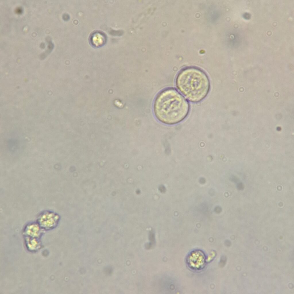 transitional epithelial cells in urine
