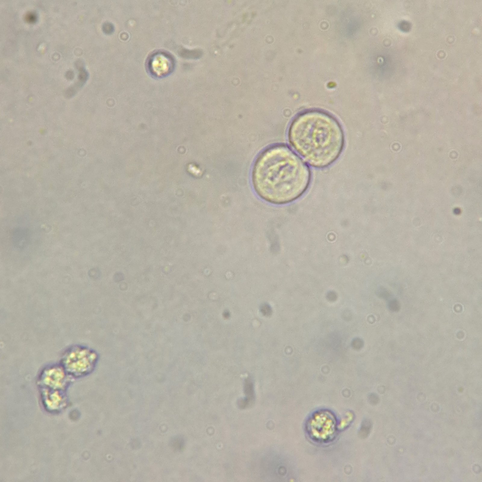 Transitional epithelial cells in urine