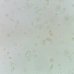 Transitional Epithelial Cells - MedLabBuddy