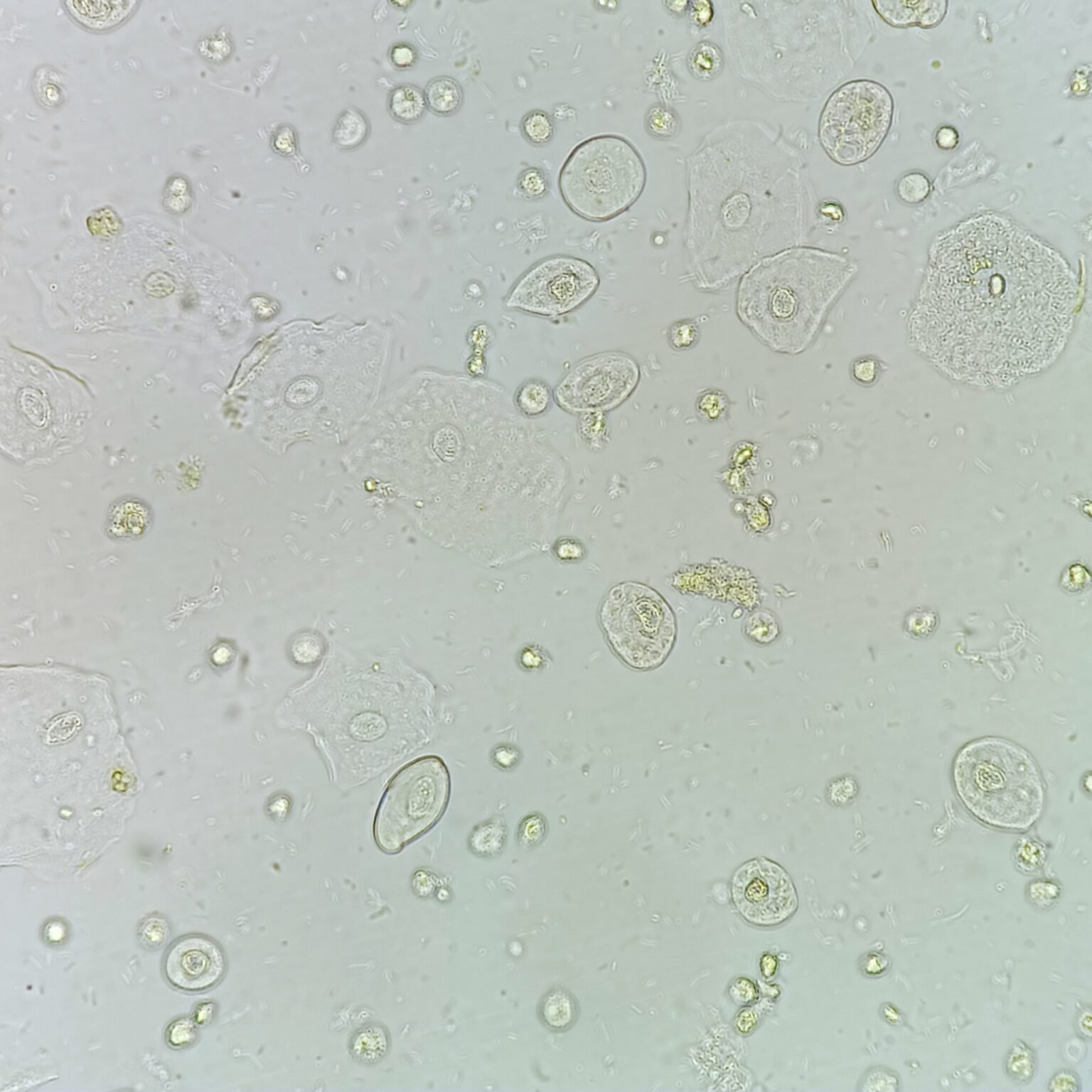 Transitional Epithelial Cells - MedLabBuddy