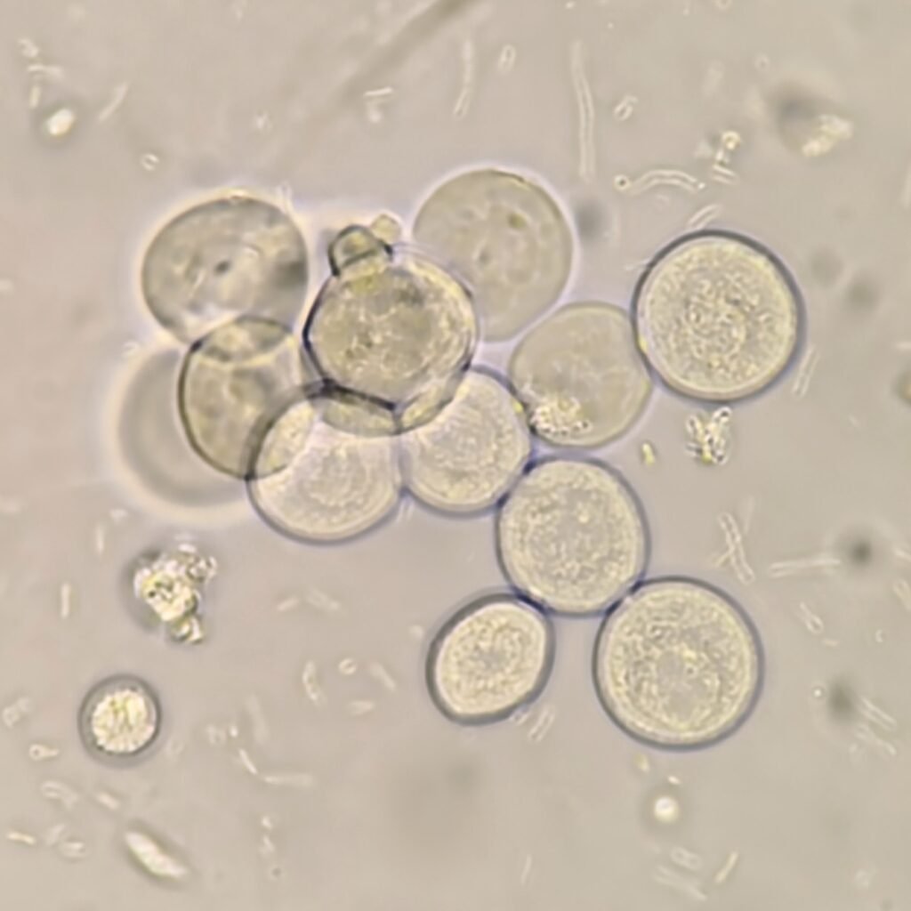 Transitional epithelial cells in urine