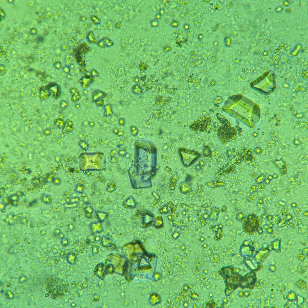 Triple Phosphate Crystals, Coffin Lid 
