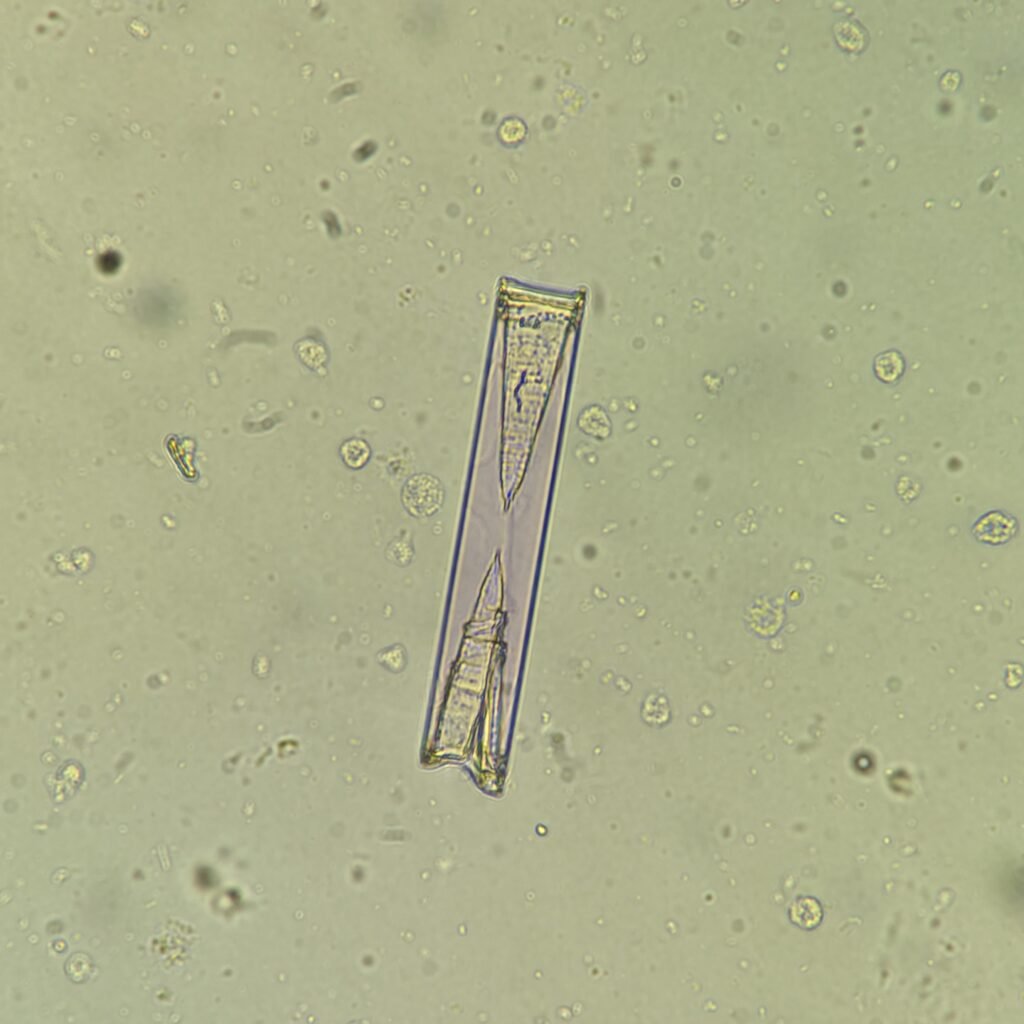 Triple Phosphate crystals in urine sediment, fern form