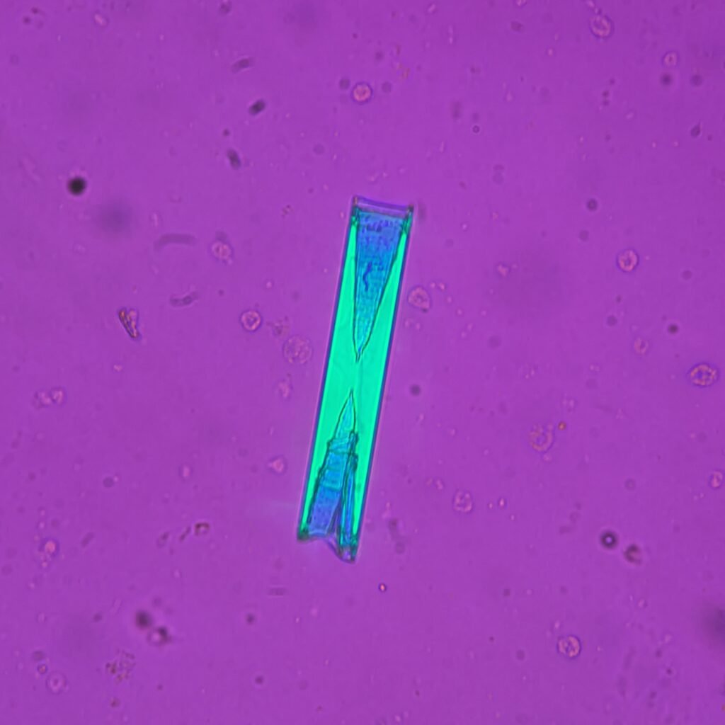 Triple Phosphate crystals in urine sediment, fern form, polarized