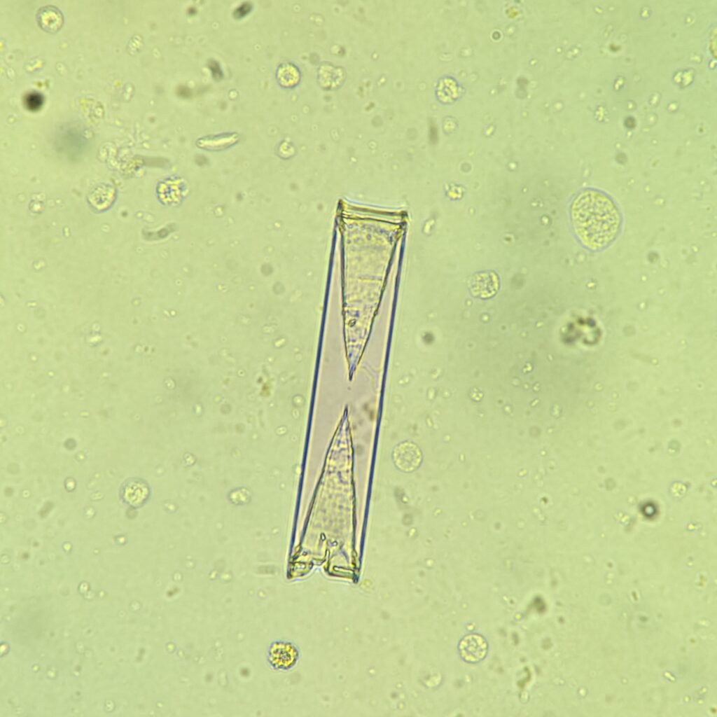Triple Phosphate crystals in urine sediment, fern form