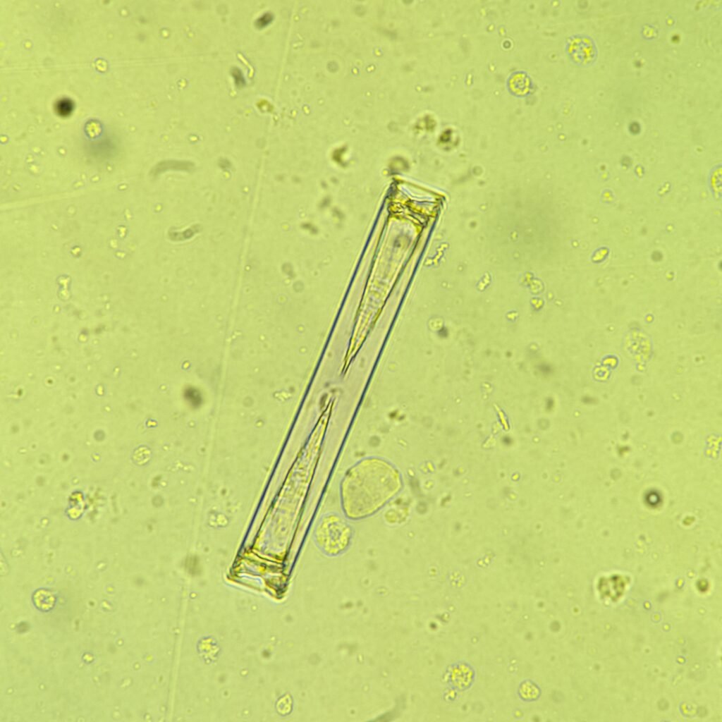 Triple Phosphate crystals in urine sediment, fern form