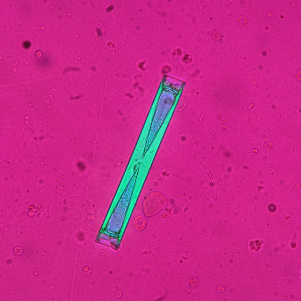 Triple Phosphate crystals in urine sediment, fern form, polarized