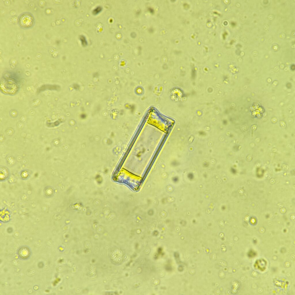 Triple Phosphate crystals in urine sediment, fern form