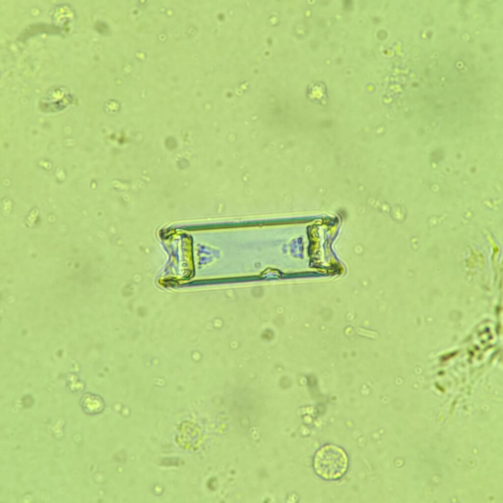 Triple Phosphate crystals in urine sediment, fern form