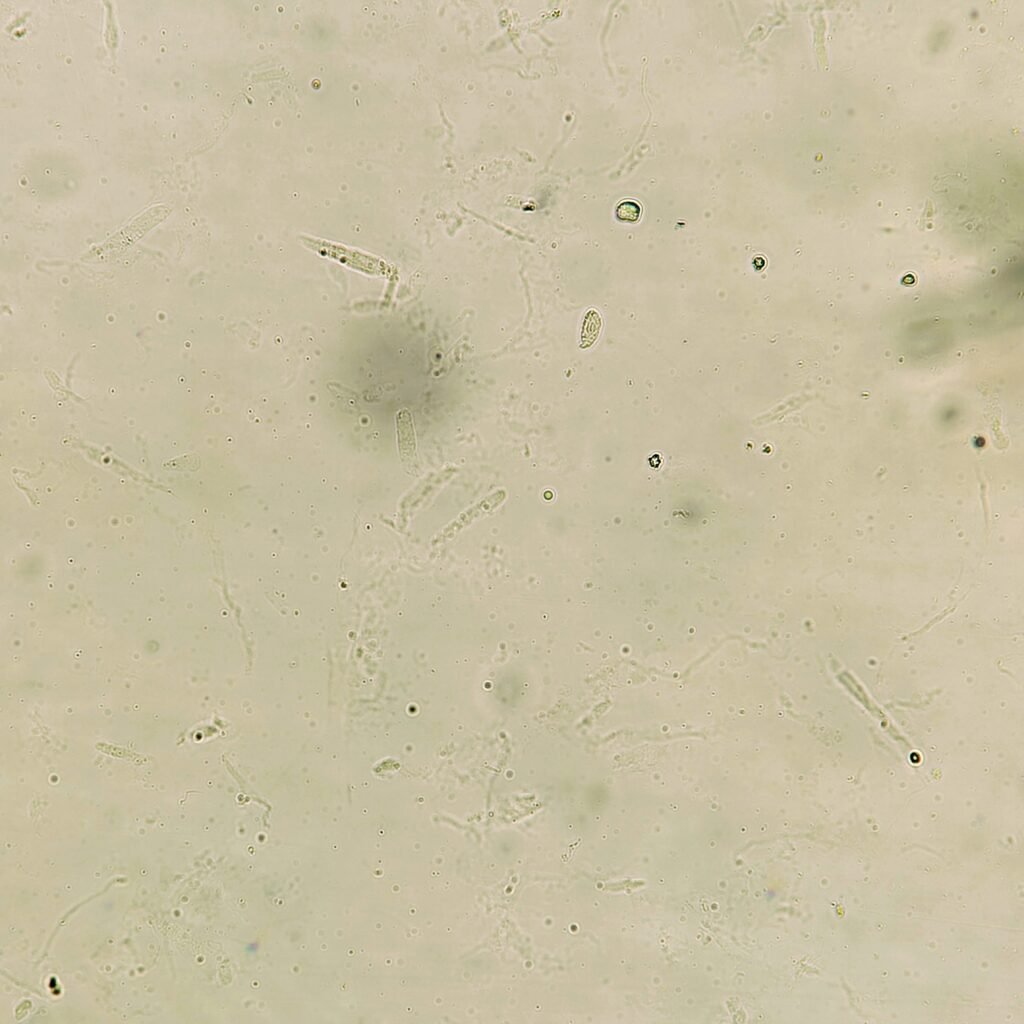Hyaline casts in urine on low power field