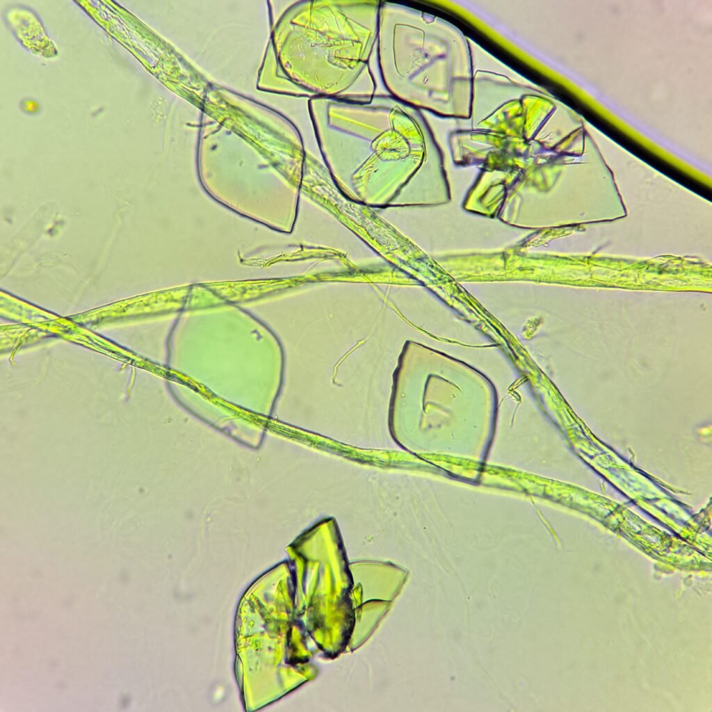 Uric Acid Crystals, Diamond/Rhomboid  & Rosette Form