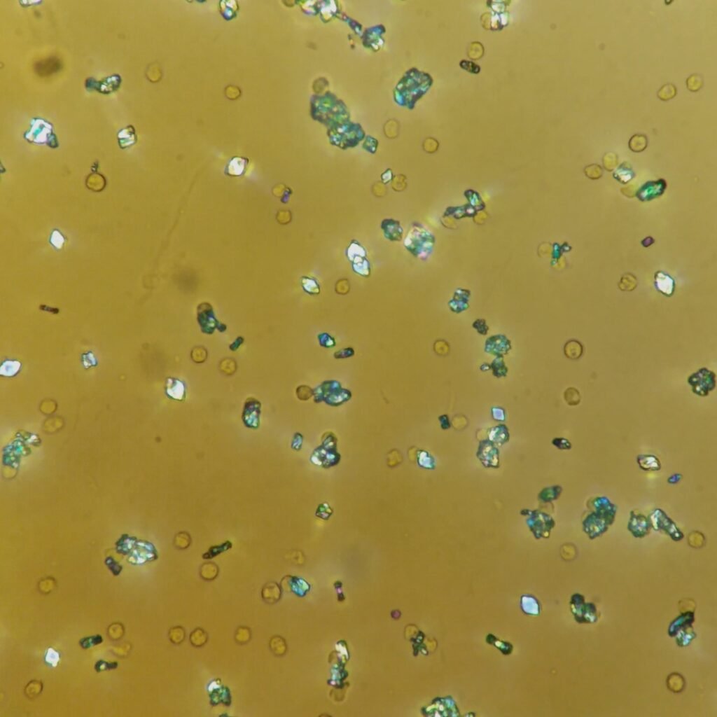 Uric Acid Crystals, Diamond/Rhomboid  & Rosette Form (Polarized)