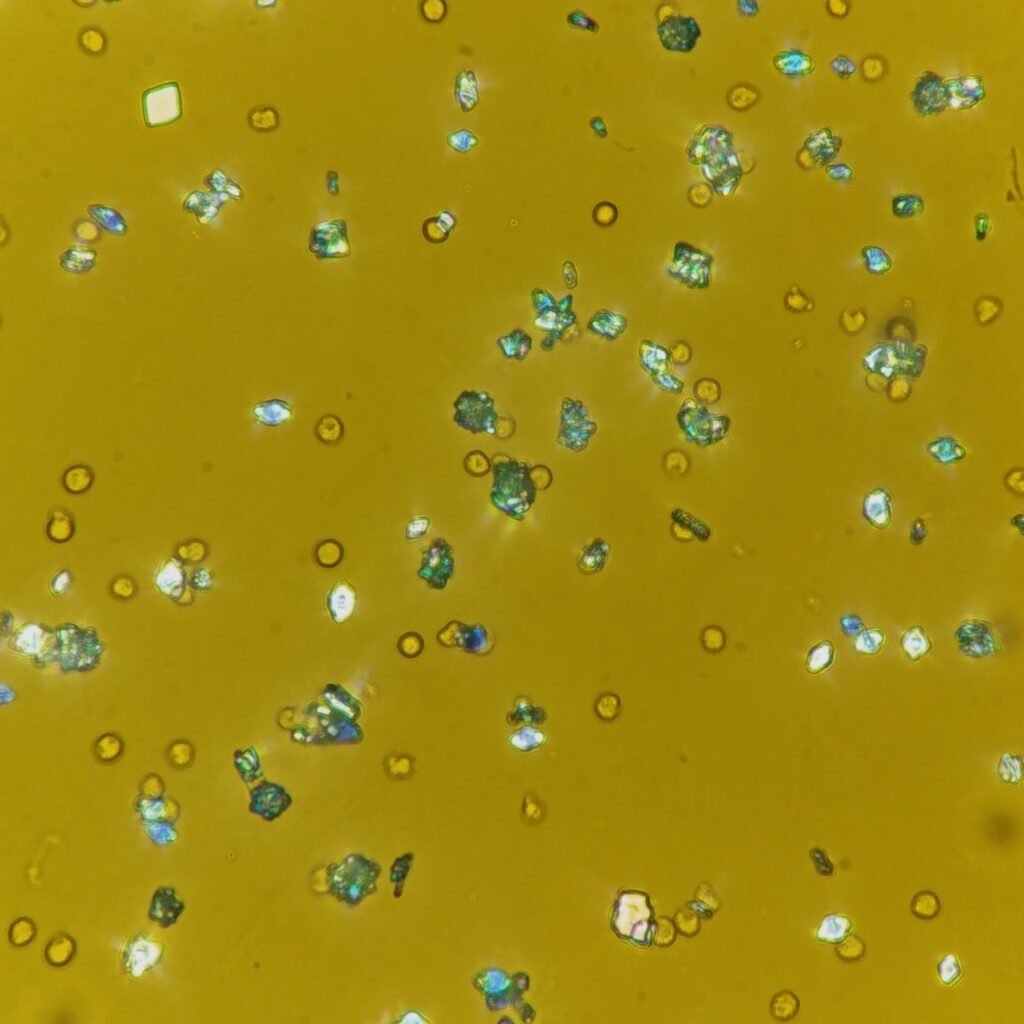 Uric Acid Crystals, Diamond/Rhomboid  & Rosette Form (Polarized)