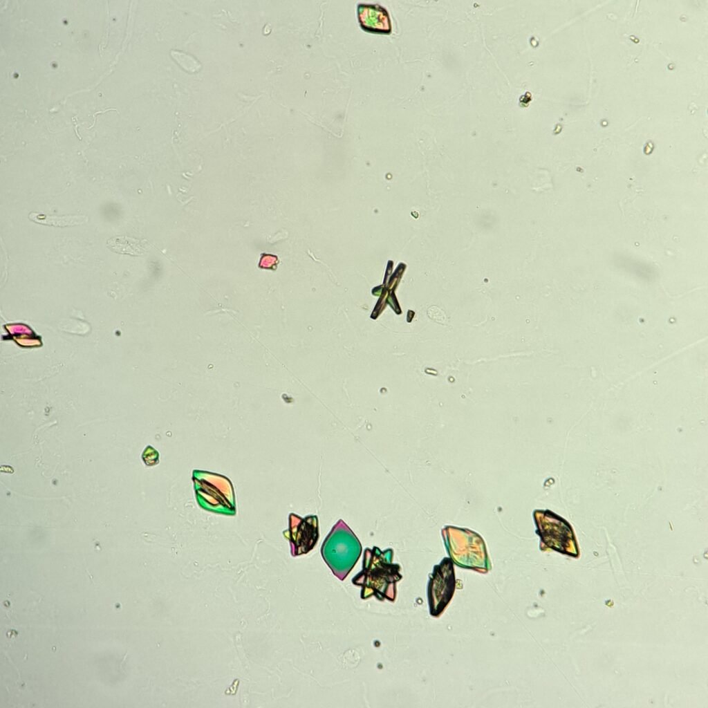 Uric Acid Crystals, Diamond/Rhomboid  & Rosette Form (Polarized)