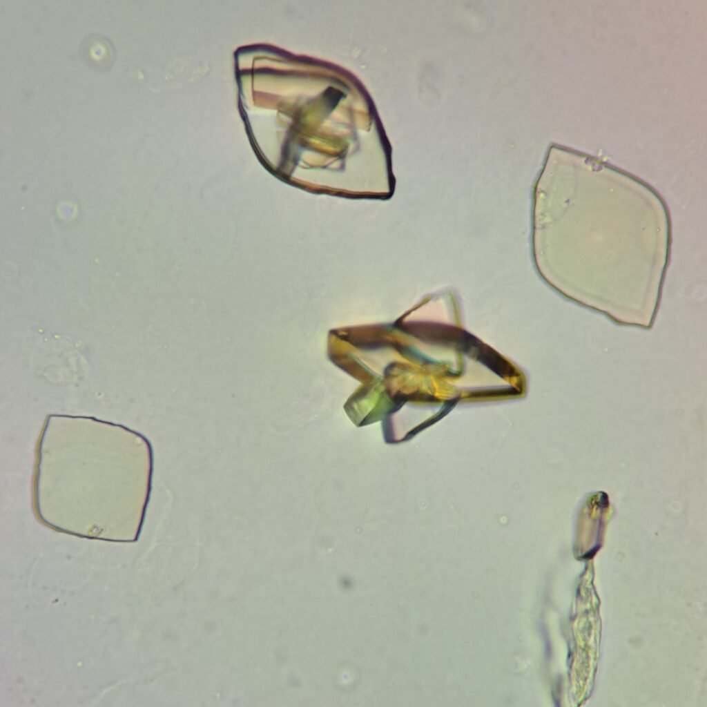 Uric Acid Crystals, Diamond/Rhomboid  & Rosette Form