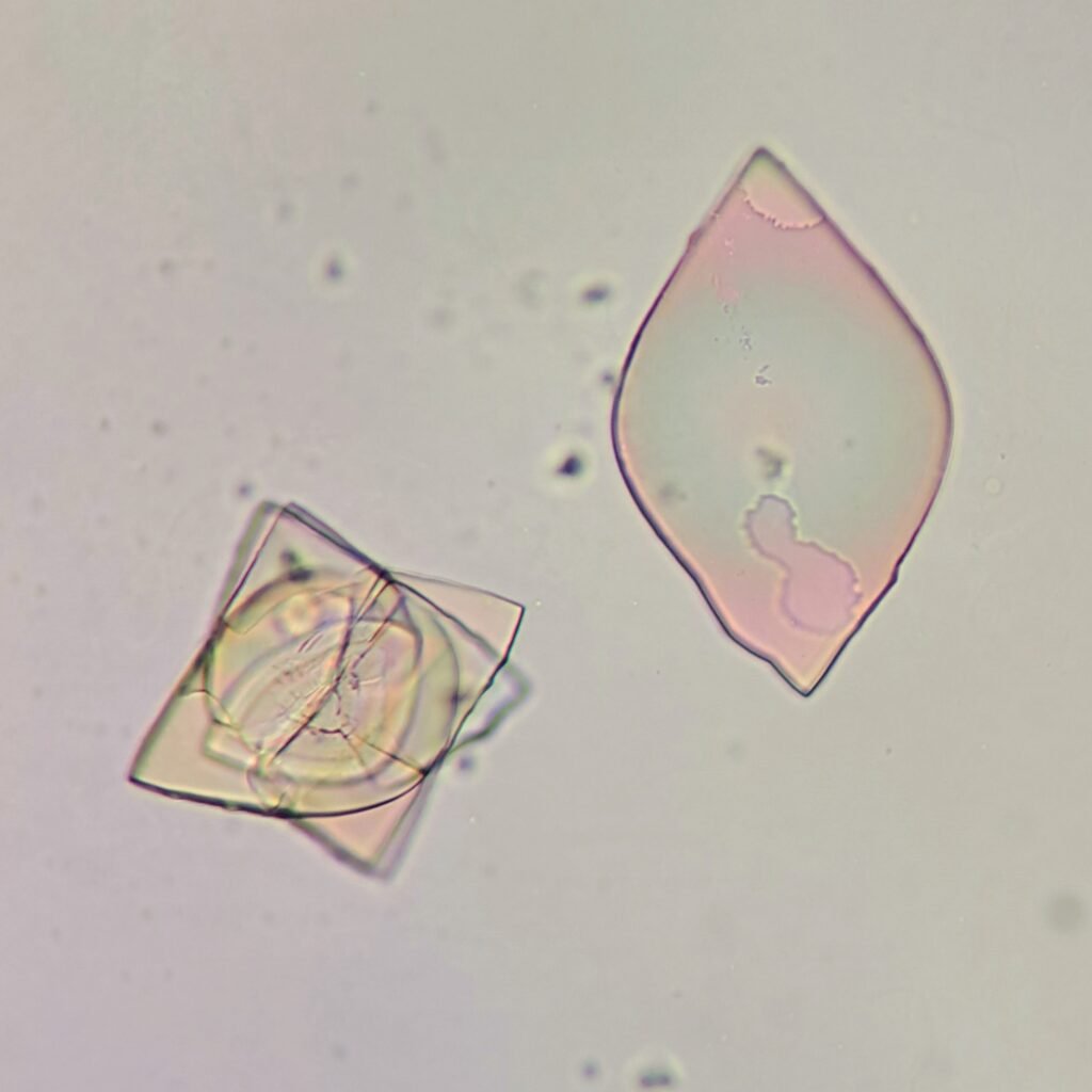 Uric Acid Crystals, Diamond/Rhomboid  & Rosette Form