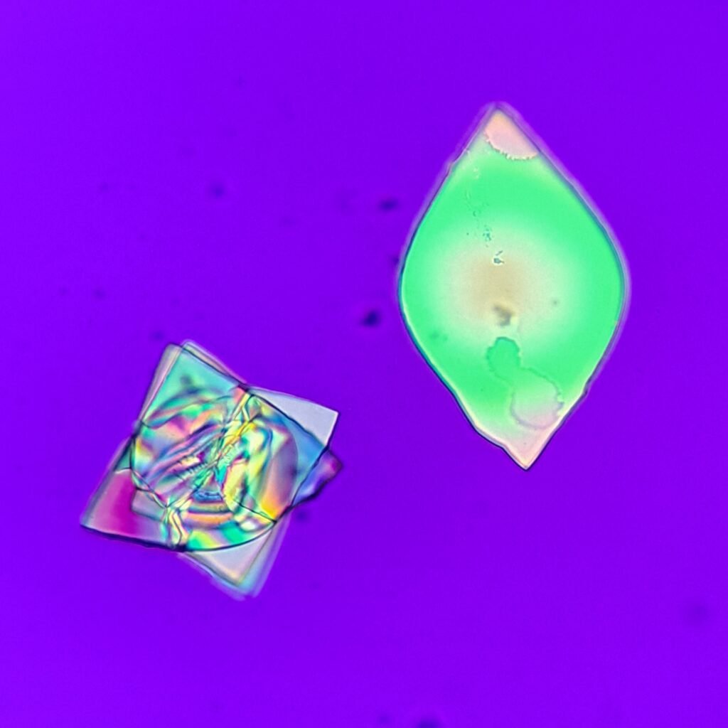 Uric Acid Crystals, Diamond/Rhomboid  & Rosette Form (Polarized)