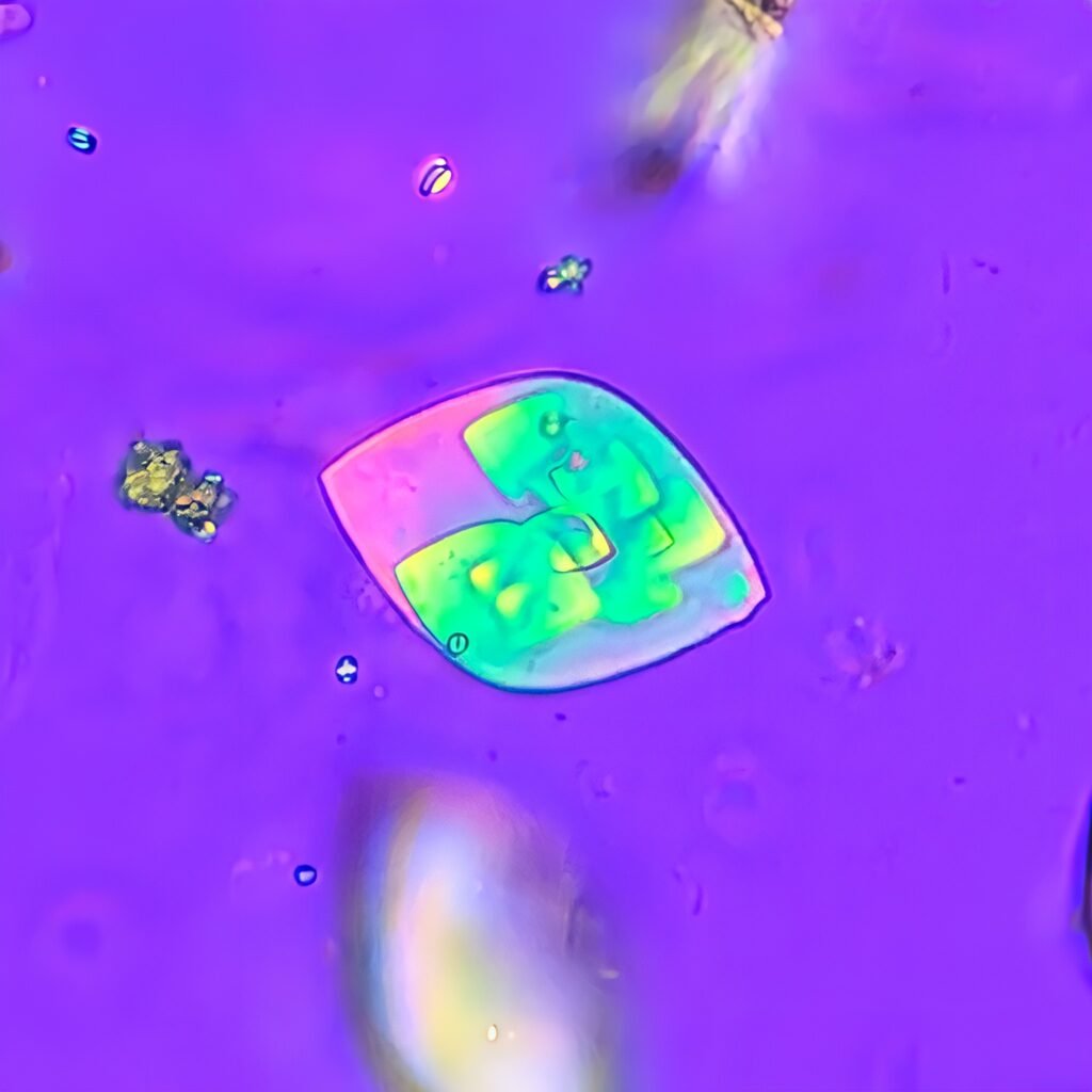 Uric acid crystals in urine, rhomboid, polarized