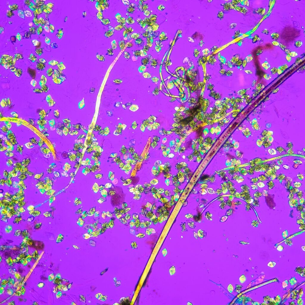 Uric acid crystals in urine, rhomboid, polarized