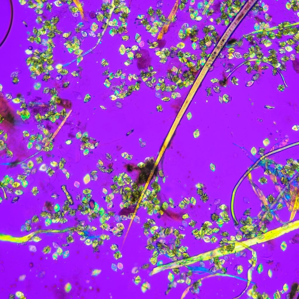 Uric acid crystals in urine, rhomboid, polarized