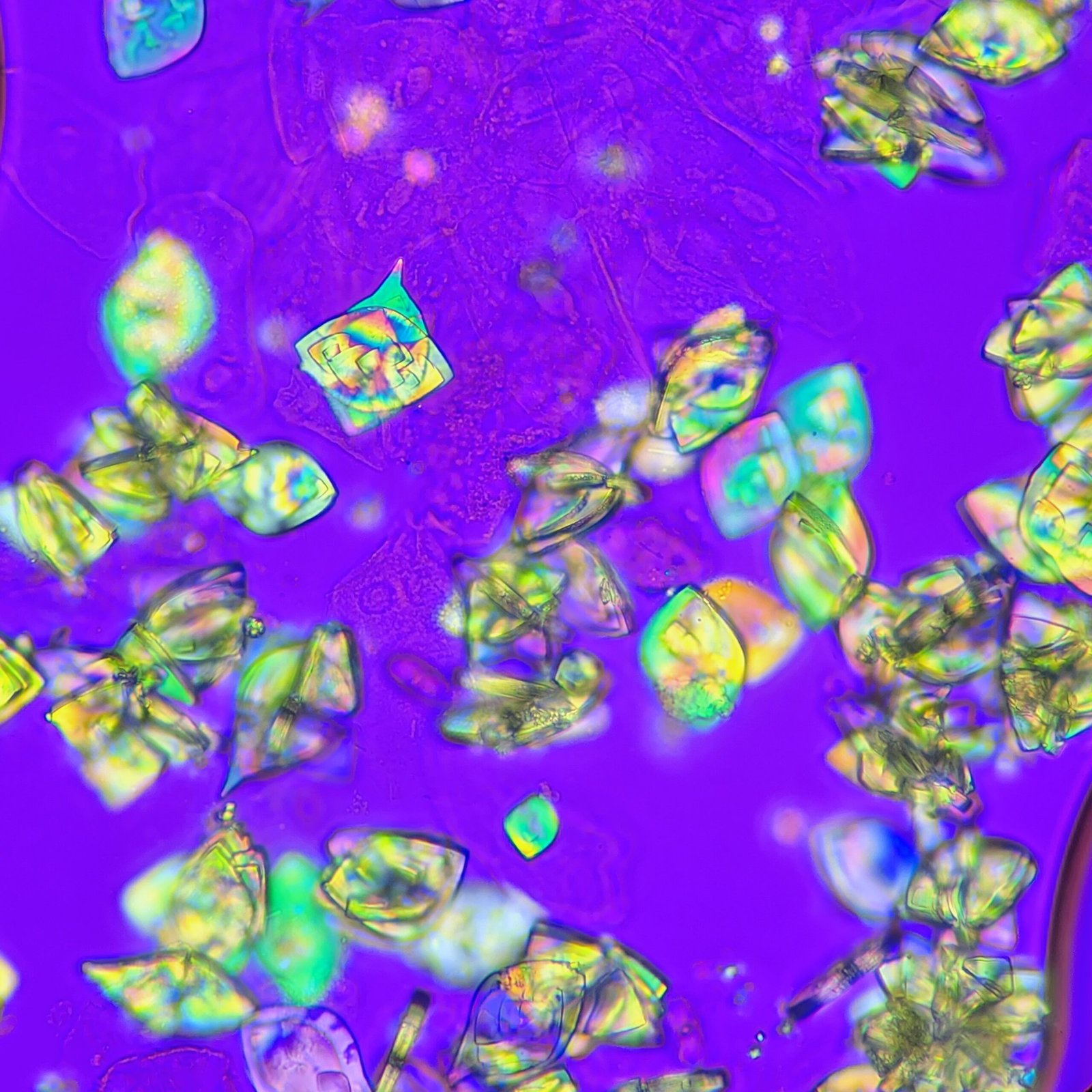 Uric Acid Crystals Polarized Light