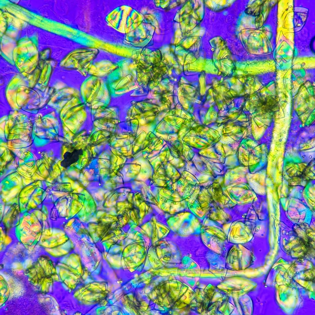 Uric acid crystals in urine, rhomboid, polarized