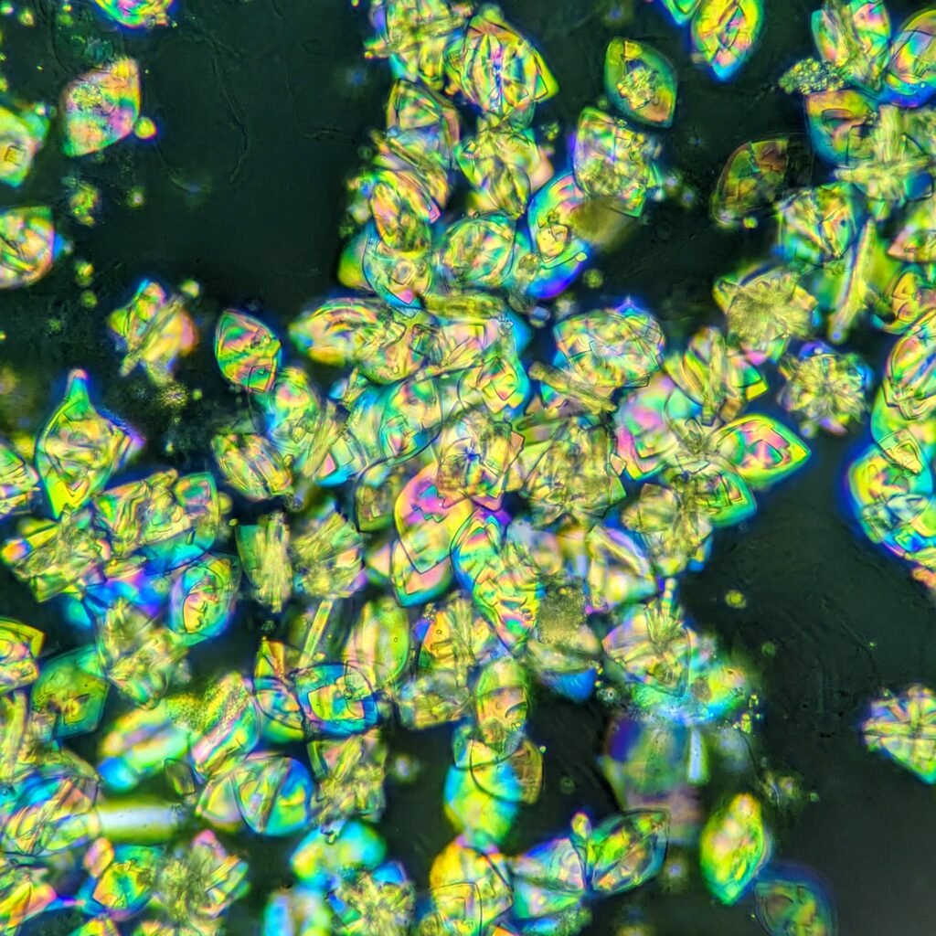 Uric acid crystals in urine, rhomboid, polarized