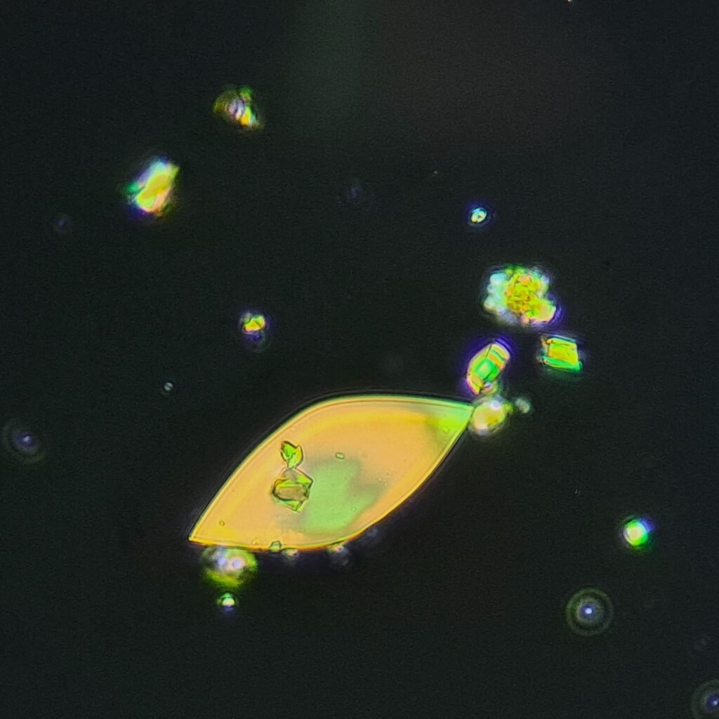 Uric Acid Crystals, Diamond/Rhomboid  & Rosette Form (Polarized)