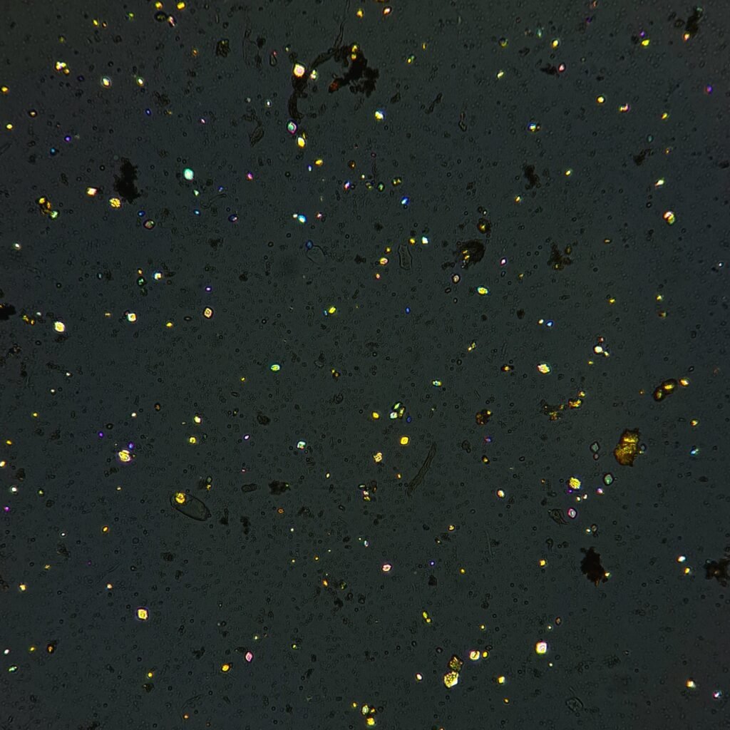 Uric Acid Crystals, Diamond/Rhomboid  & Rosette Form (Polarized)