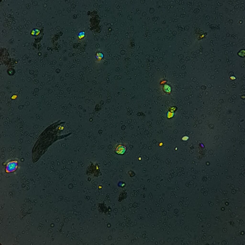 Uric Acid Crystals, Diamond/Rhomboid Form (Polarized)