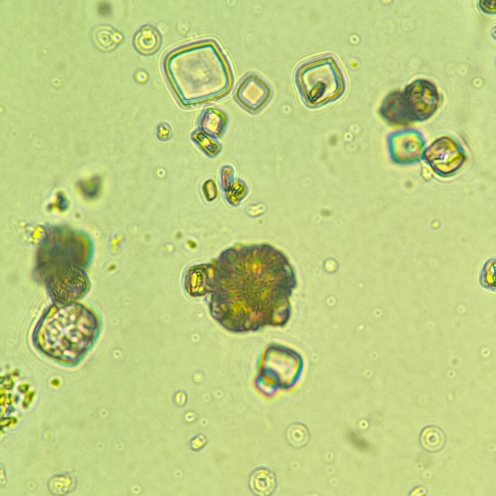 Uric Acid Crystals, Rosette Form