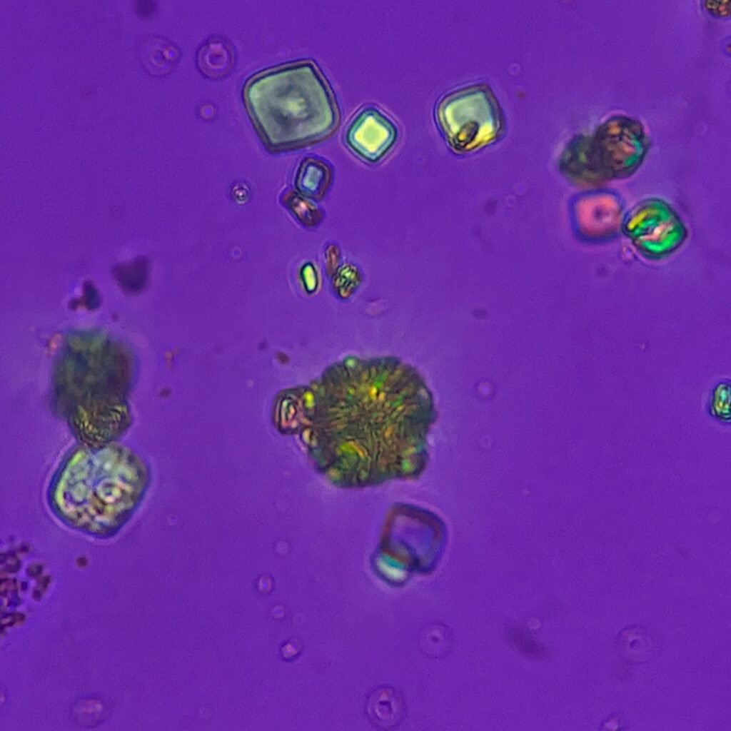 Uric acid crystals in urine, rosette, polarized