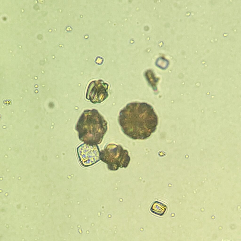 Uric Acid Crystals, Rosette Form