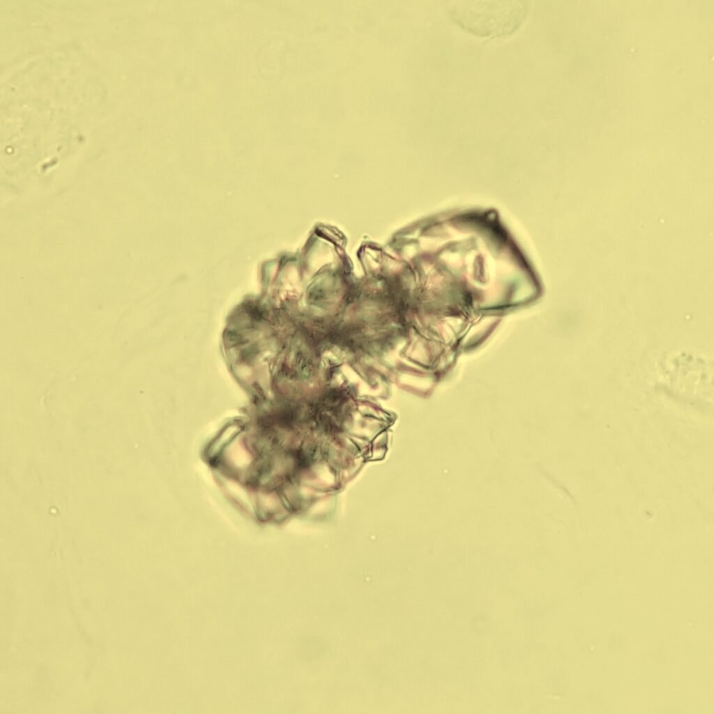 Uric Acid Crystals, Rosette Form