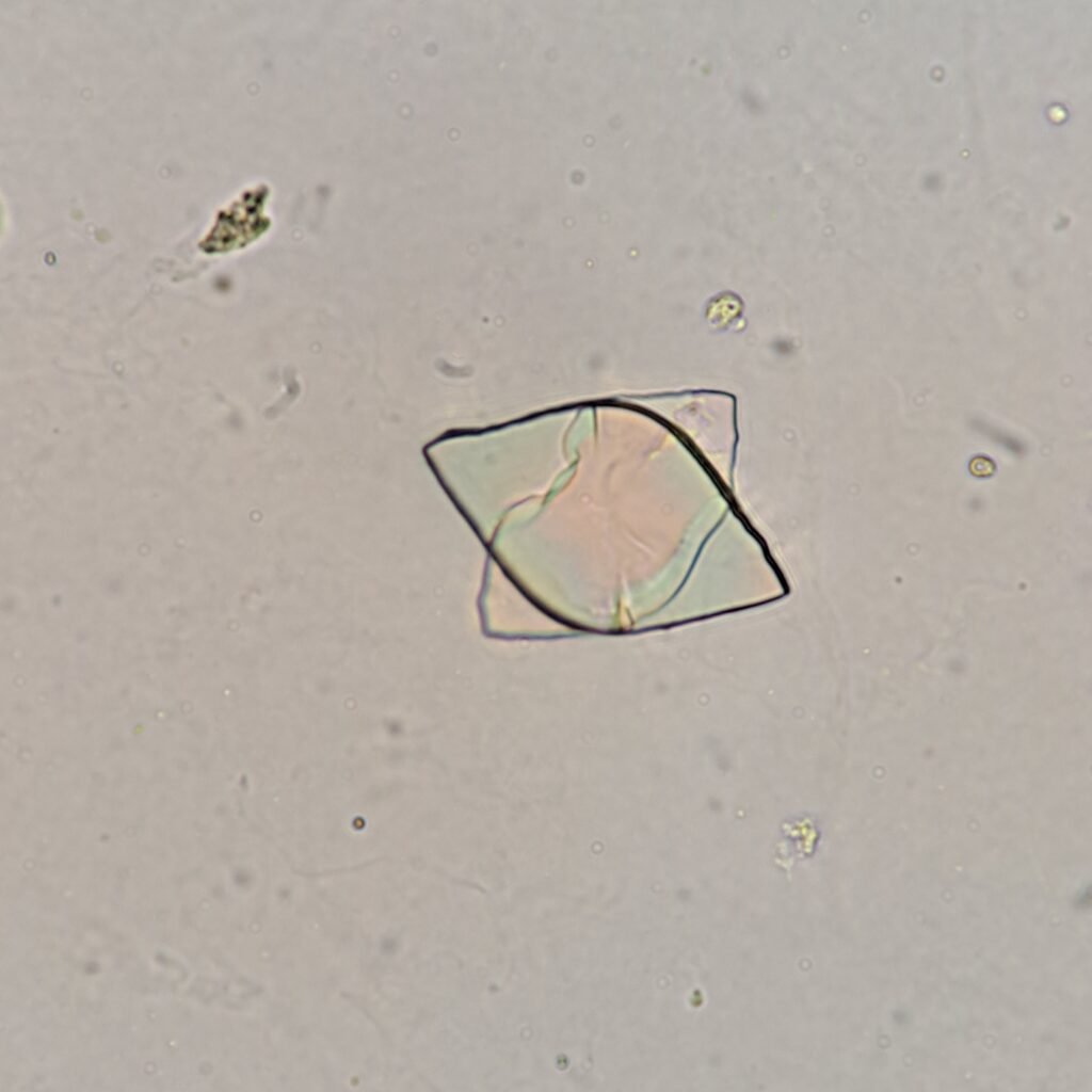 Uric Acid Crystals, Diamond/Rhomboid  & Rosette Form