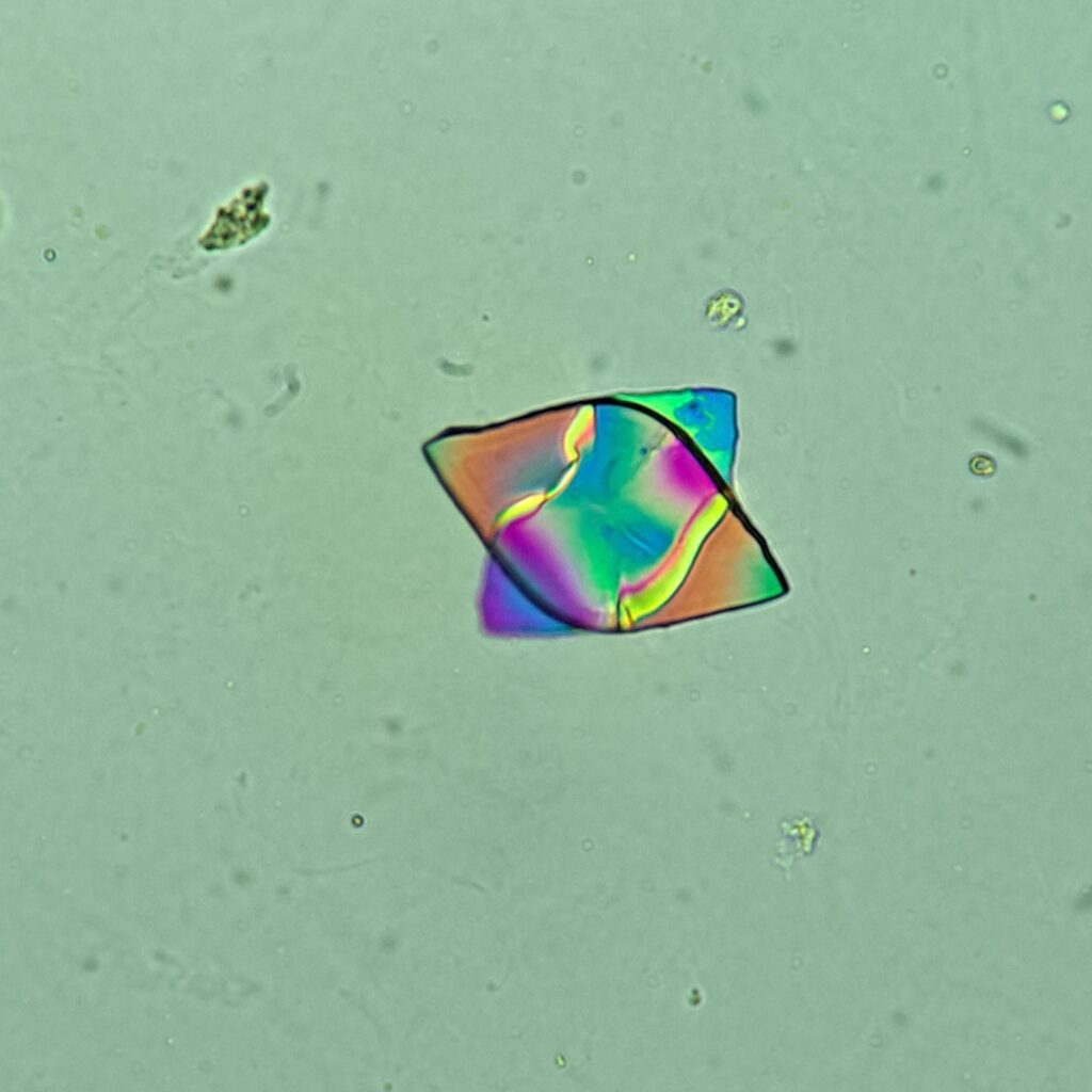 Uric Acid Crystals, Diamond/Rhomboid  & Rosette Form (Polarized)