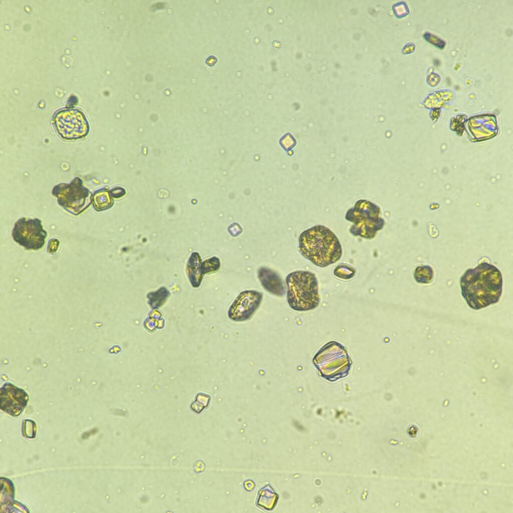 Uric Acid Crystals, Rosette Form