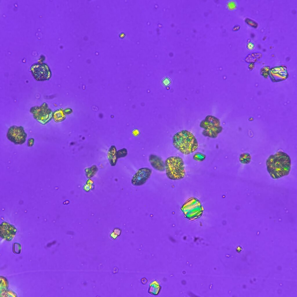 Uric acid crystals in urine, rosette, polarized