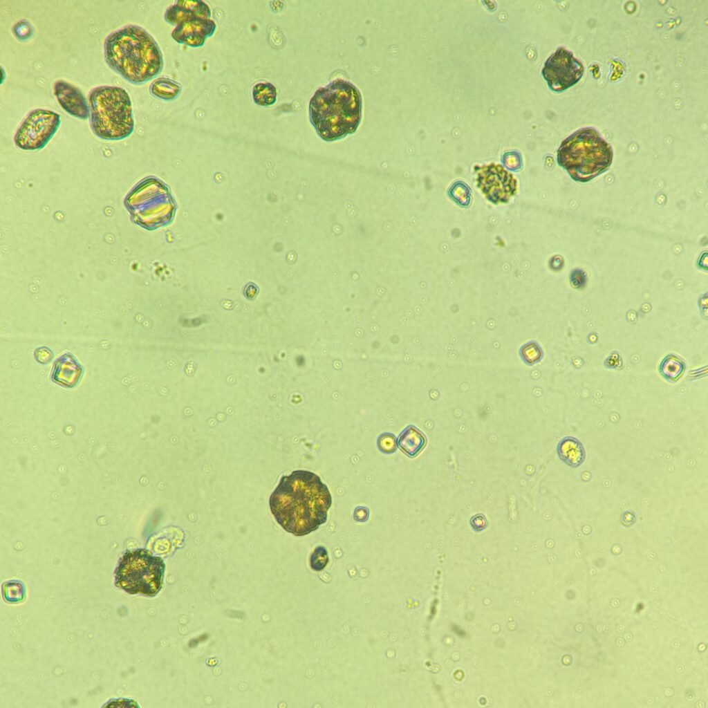 Uric Acid Crystals, Rosette Form