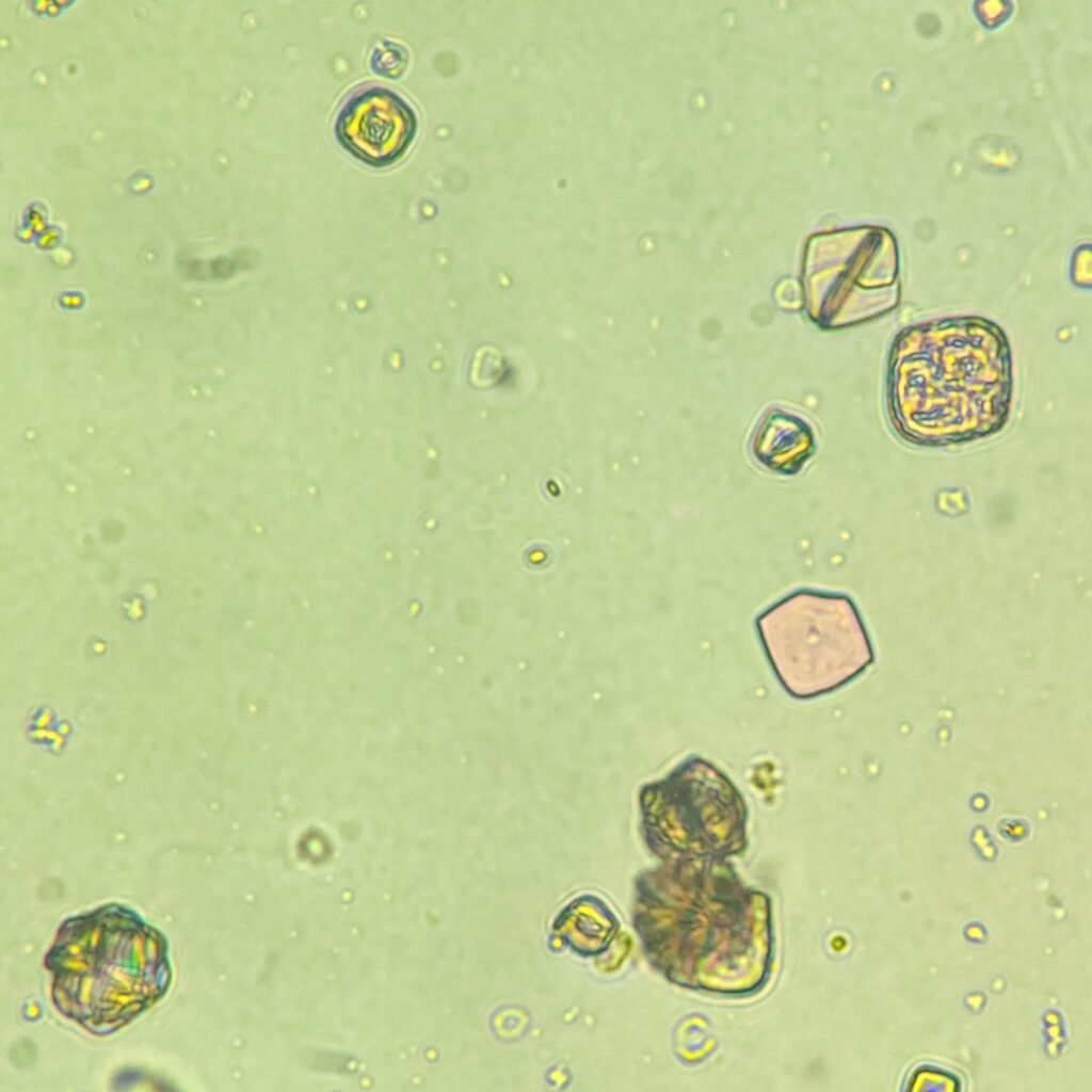 Uric Acid Crystals, Rosette Form