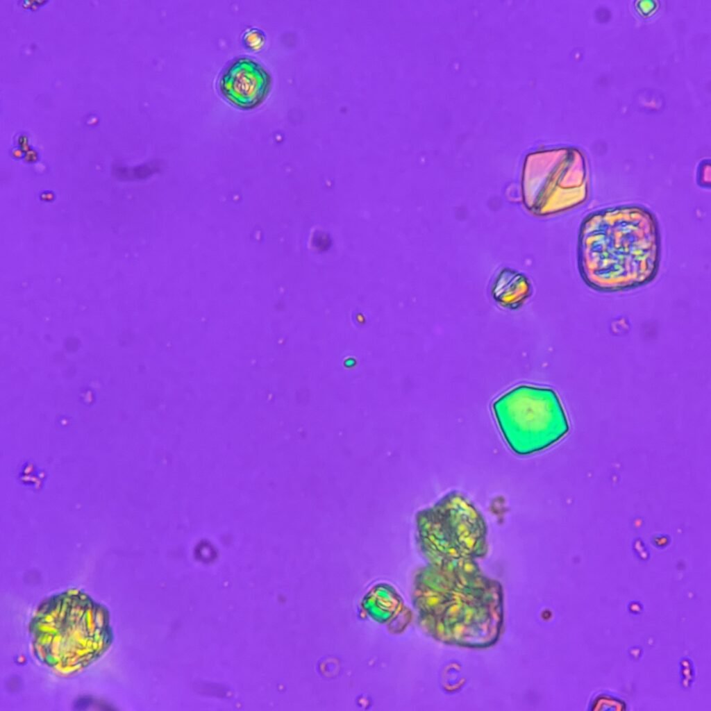 Uric acid crystals in urine, rosette, polarized