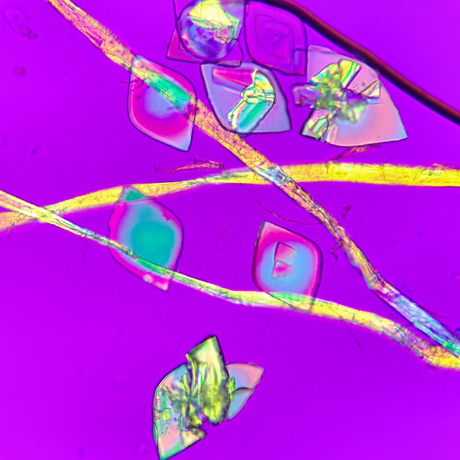 Uric acid crystals in urine, rhomboid, polarized